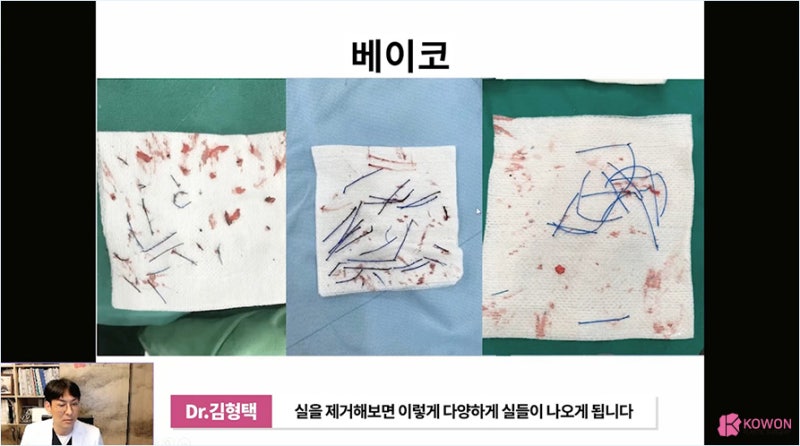 코재수술시기 부작용 최소화하는 코실 제거 병원 사진 6