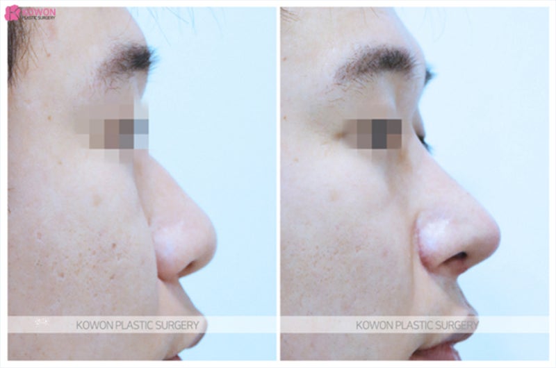 콧망울축소 밋밋한 이미지 개선과 남자코성형비용 사진 8