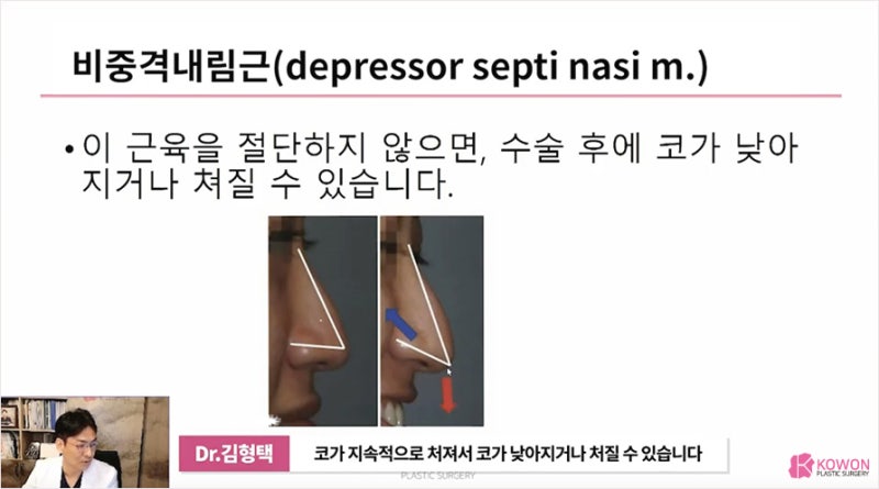 코성형외과유명한곳 코근육 쳐진코 개선방법 사진 11