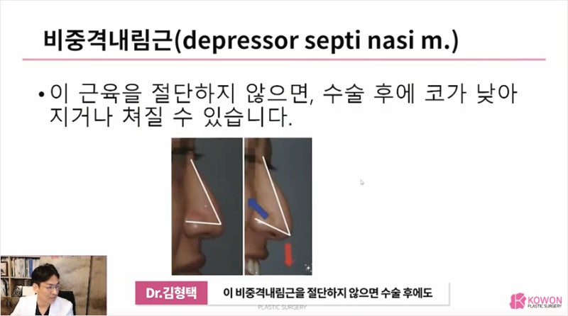 코성형외과유명한곳 코근육 쳐진코 개선방법 사진 10