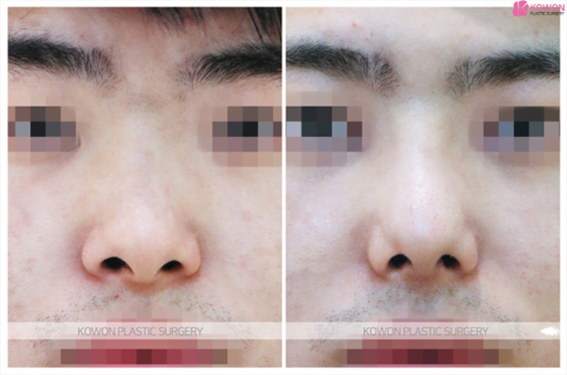남자코재수술 확실한 비중격교정술 전후 사진 5