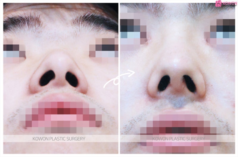 남자코재수술 확실한 비중격교정술 전후 사진 6