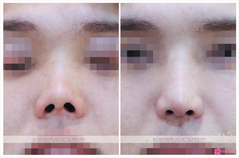 코수술구축 잘하는 병원 및 남자코성형비용 사진 4