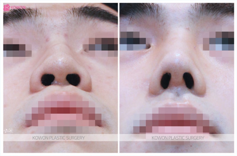 코끝재수술 코끝묶기로 매부리 개선 효과 사진 6