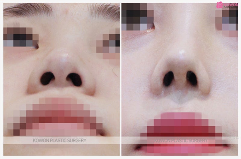 여자코성형후기 예쁜 직반코 만족도 높은곳 사진 6