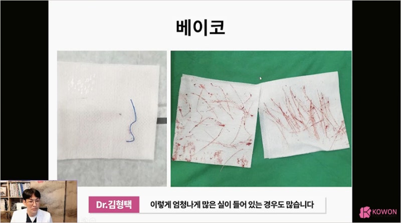 코수술종류 하이코염증 제거는 신사역성형외과 사진 8