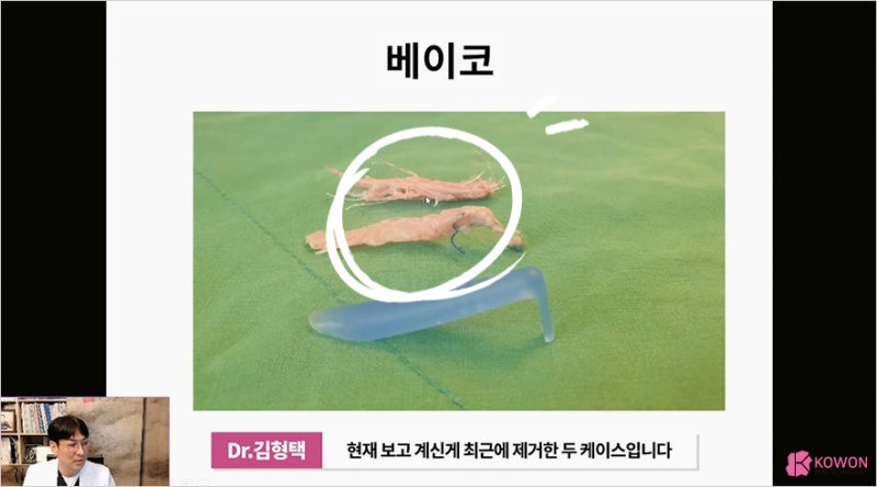 코수술종류 하이코염증 제거는 신사역성형외과 사진 10