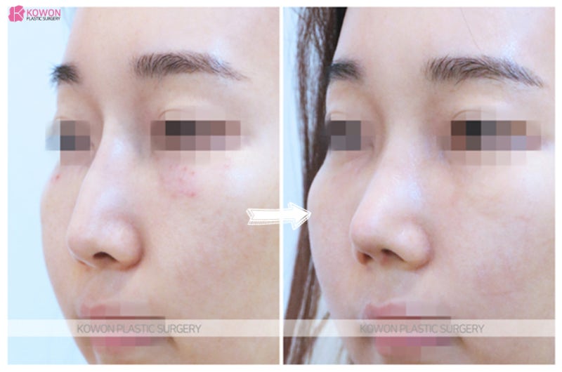 강남코성형 잘하는곳에서 동안외모 코끝높이기 사진 6