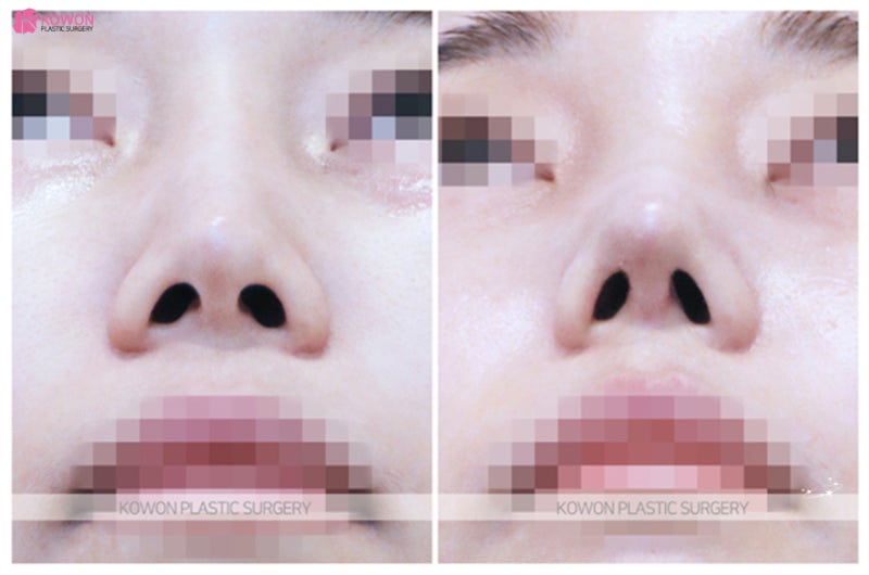 강남코성형 잘하는곳에서 동안외모 코끝높이기 사진 7