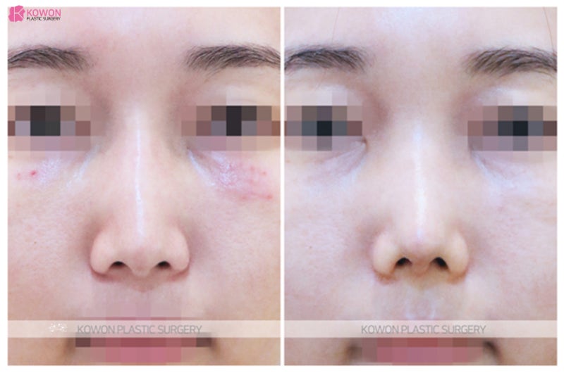 강남코성형 잘하는곳에서 동안외모 코끝높이기 사진 8