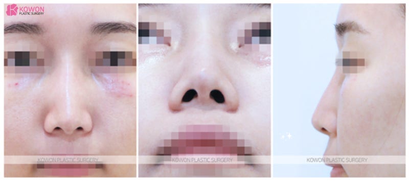강남코성형 잘하는곳에서 동안외모 코끝높이기