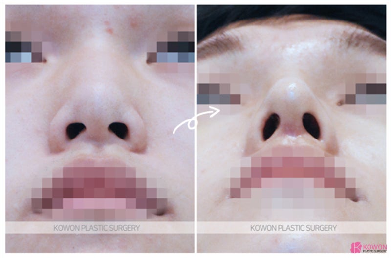 서울코성형 유명한곳 남자 비공내리기 사진 6