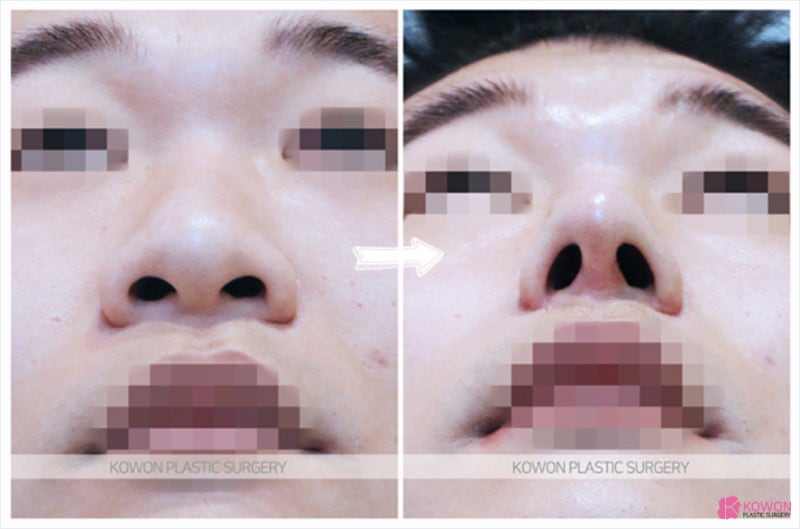 남자연예인코 같은 매끈한 코라인 및 콧볼줄이기 사진 4