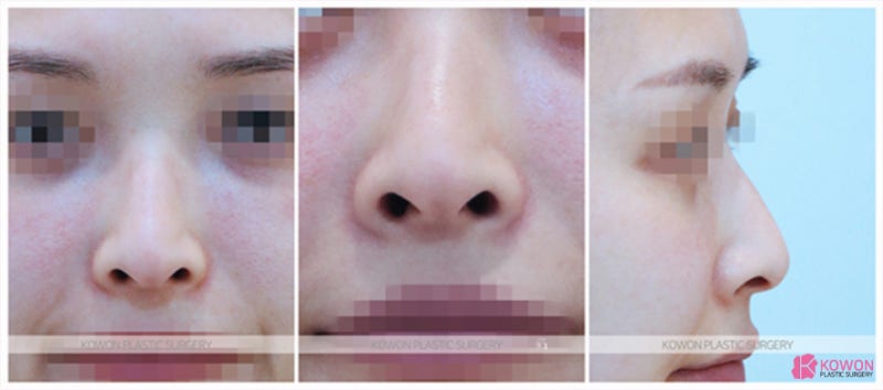 콧대세우기 자연스러운 코수술콧구멍 노출 줄이기