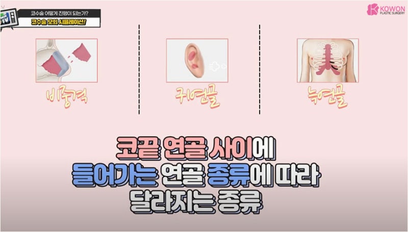 매부리코수술 성형시뮬레이션으로 간접 경험해보기 사진 5
