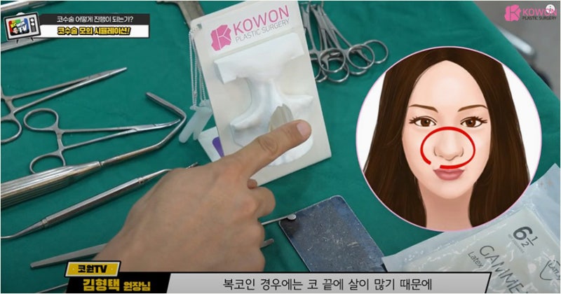 매부리코수술 성형시뮬레이션으로 간접 경험해보기 사진 9