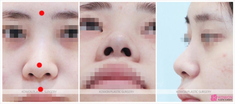 뚱뚱한코 퍼져있는 여자복코 오똑하게 만드는법