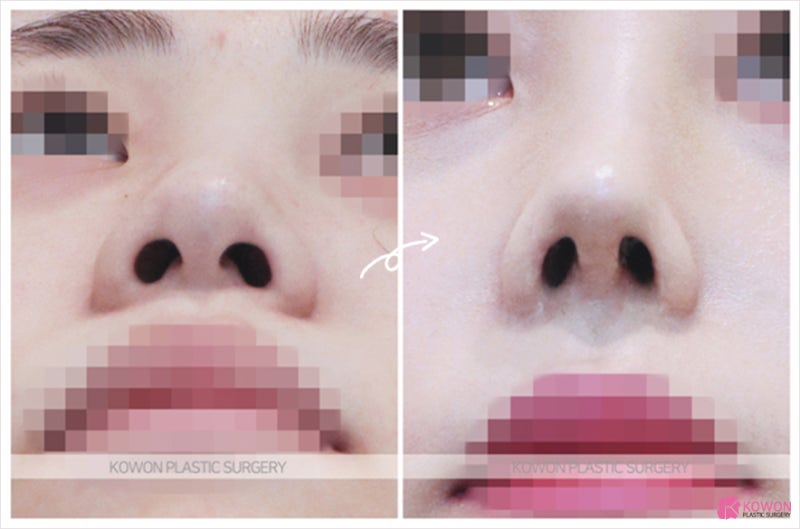 뚱뚱한코 퍼져있는 여자복코 오똑하게 만드는법 사진 6