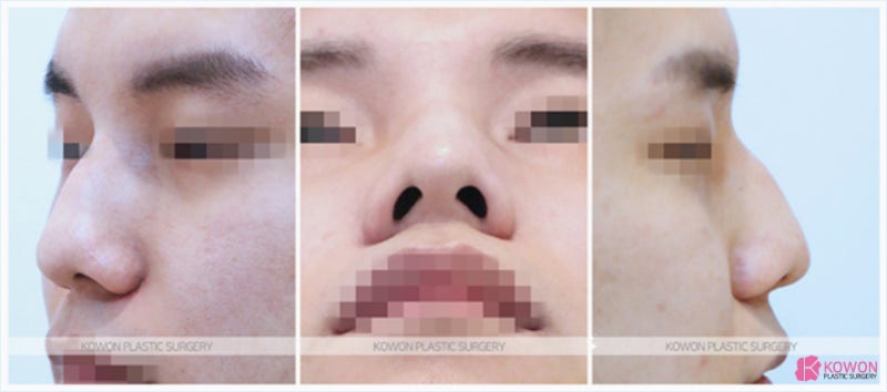 비중격만곡증코성형 휘어진 남자매부리코 개선 사진 3