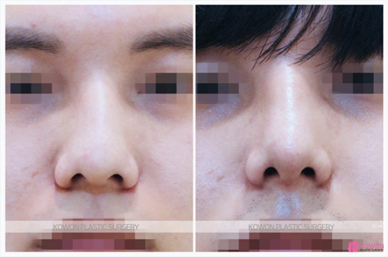 비중격만곡증코성형 휘어진 남자매부리코 개선 사진 5