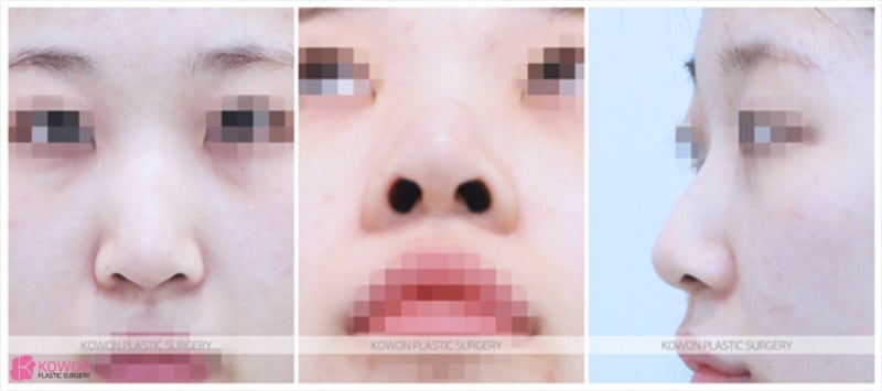 긴코성형 켈로이드성피부 흉터 없이 빠른 회복