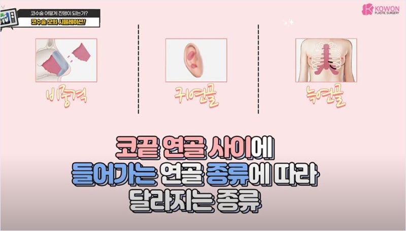 신사성형외과 수술 도구 및 복코수술 방법 사진 7