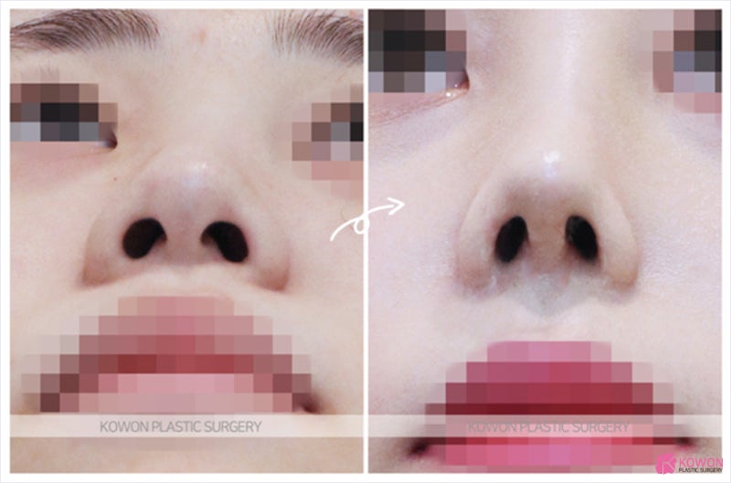 필러녹이는주사 날렵한 코끝 코성형외과유명한곳 사진 6