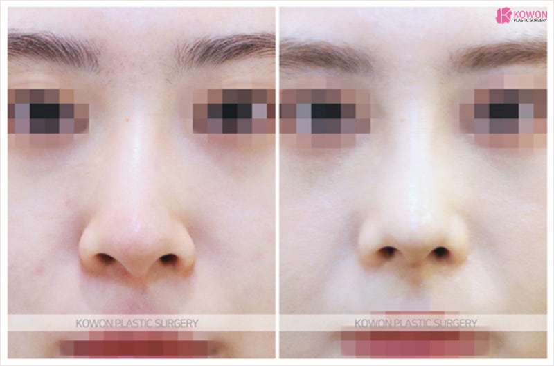 코끝연골묶기 후기 휜코수술비용 합리적인곳 사진 7