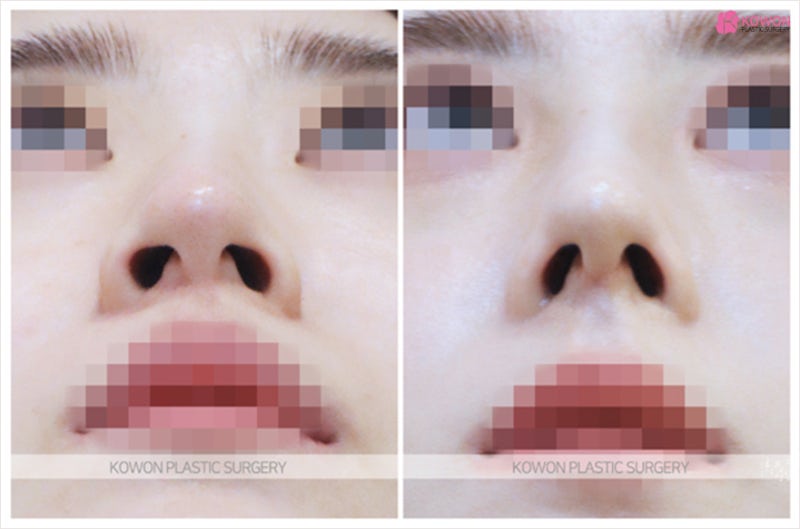 코끝연골묶기 후기 휜코수술비용 합리적인곳 사진 6