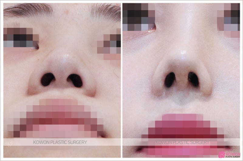 직반버선코 만들기 비중격연장 통한 개선사례 사진 6