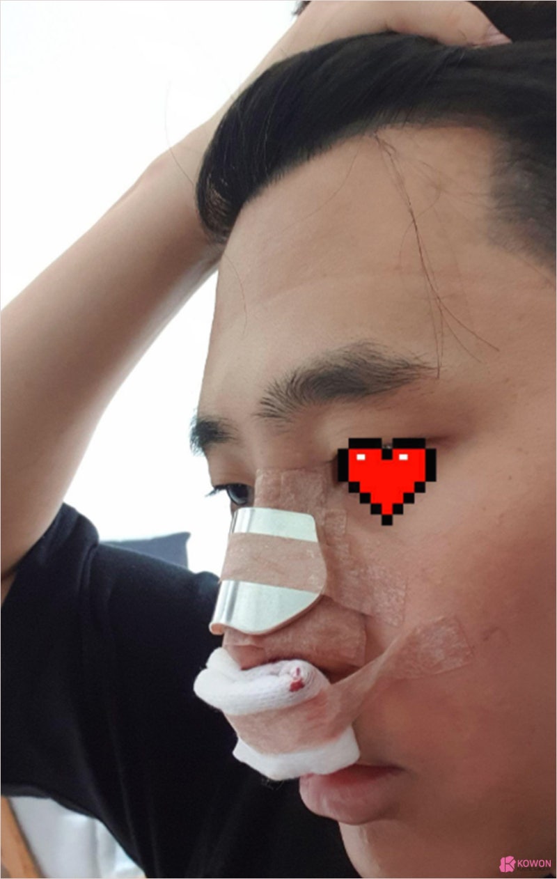 코원으로 선택하길 잘 한것 같습니다 (코원남자코성형후기) 사진 3