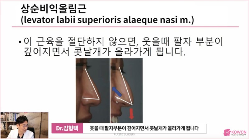 압구정성형외과 처지는 화살코수술 잘하는 곳 사진 10