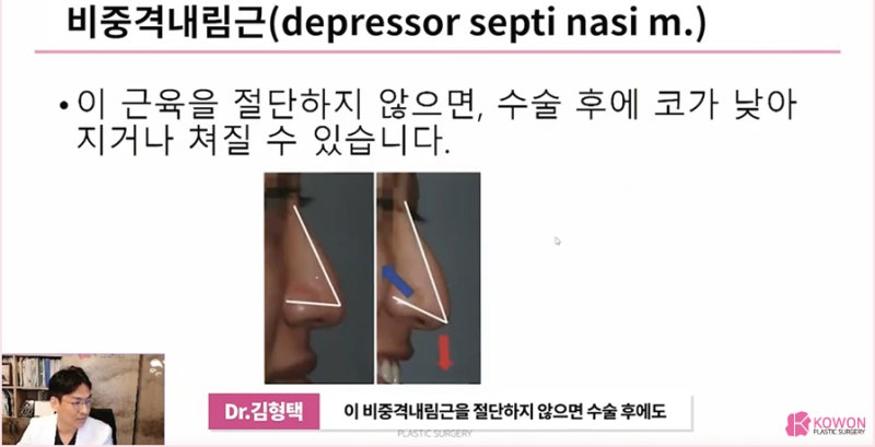 압구정성형외과 처지는 화살코수술 잘하는 곳 사진 8