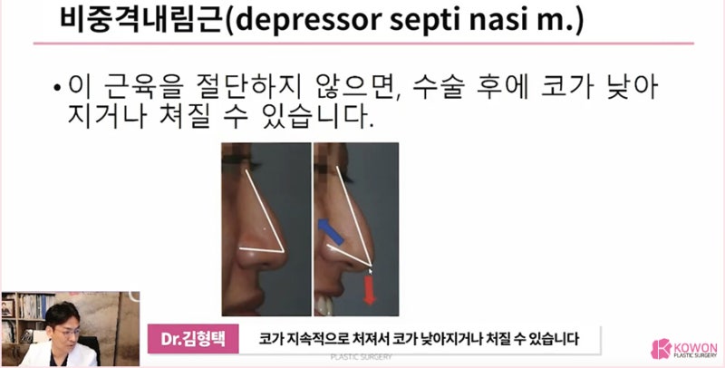 압구정성형외과 처지는 화살코수술 잘하는 곳 사진 9