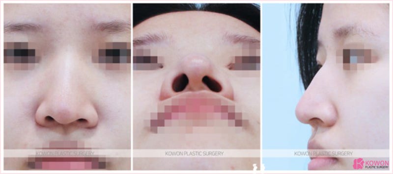 강남코성형 유명한곳에서 콧구멍성형
