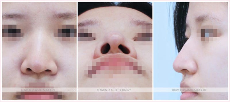 논현동성형외과 여자매부리코 교정 잘하는곳