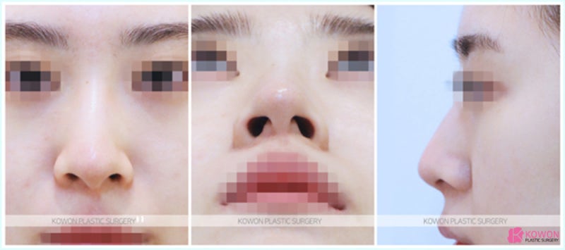 청담성형외과 유명한곳에서 성공적인 휜코수술