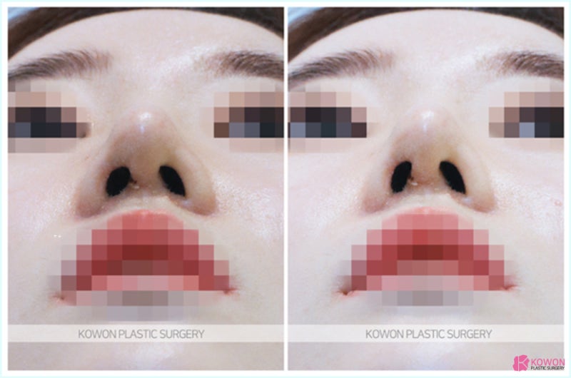 코재수술성형외과 깔끔하게 코필러실 제거 사진 8