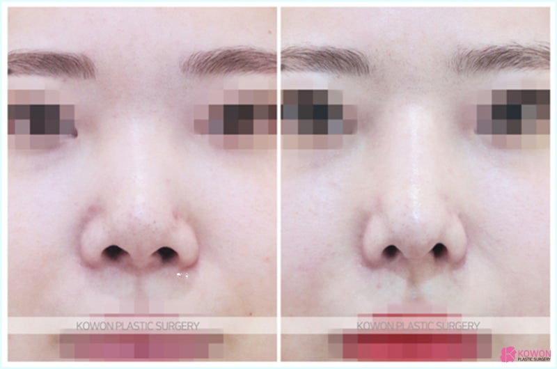 코성형유명한곳 자가늑연골 수술 전후비교 사진 5