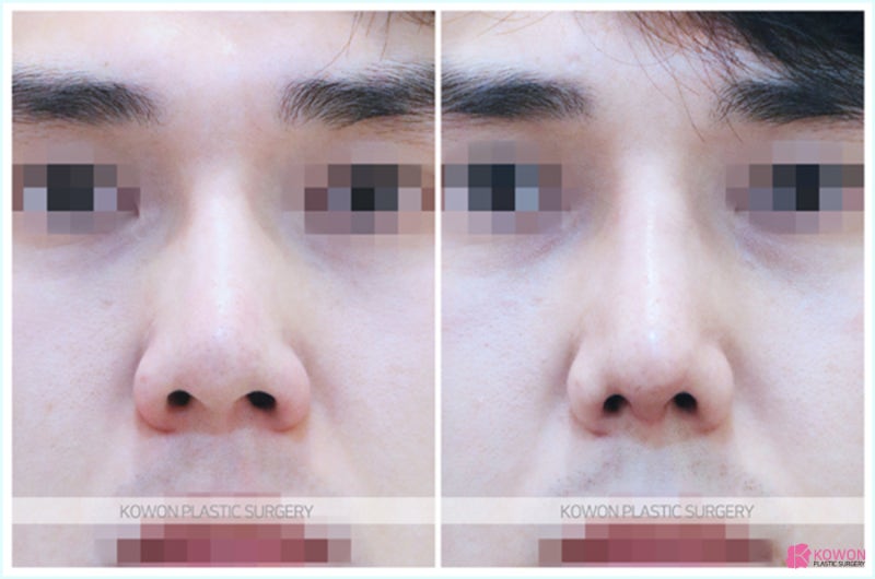 코보형물제거 완벽하게 진행하는 코재수술유명한곳 사진 8