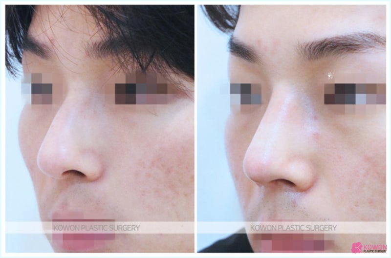 무보형물코수술 깔끔하게 진행하는 논현역성형외과 추천 사진 4