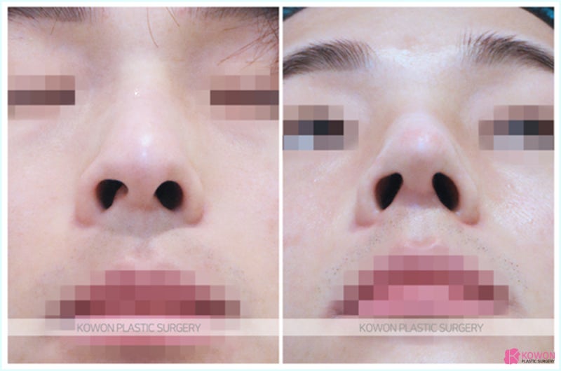 무보형물코수술 깔끔하게 진행하는 논현역성형외과 추천 사진 7