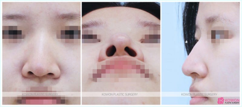 매부리코성형 전후비교 유명한 서울코성형잘하는곳 사진 3