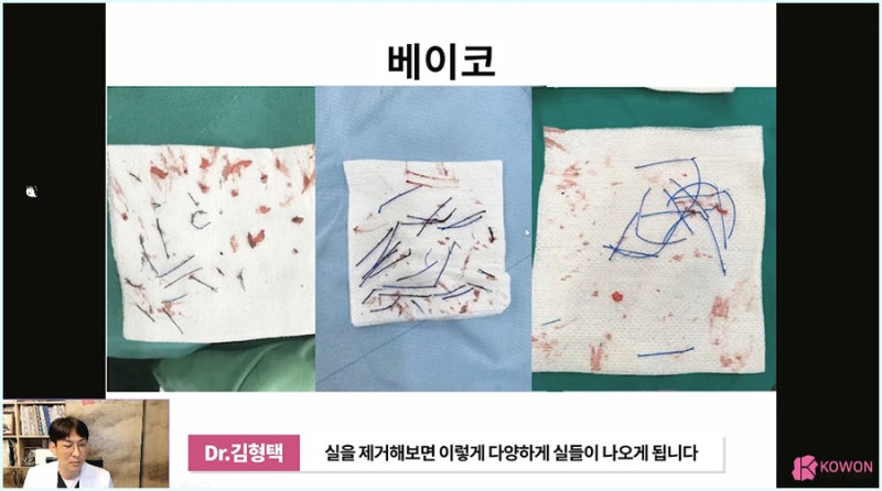 콧날개올리기 실 제거 코재수술잘하는병원 노하우 사진 6