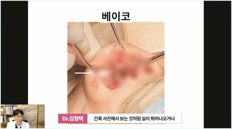 콧날개올리기 실 제거 코재수술잘하는병원 노하우 사진 5