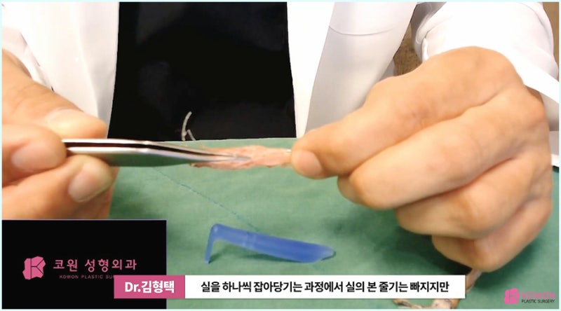 콧날개올리기 실 제거 코재수술잘하는병원 노하우 사진 12