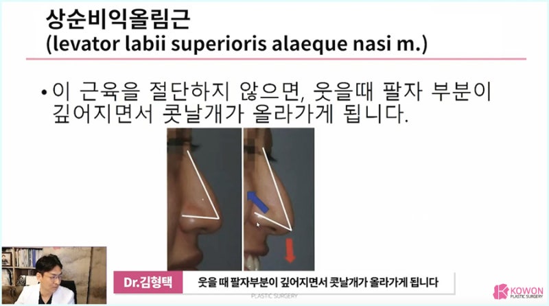 화살코성형 잘하는 곳 비중격내림근 절단 사진 12