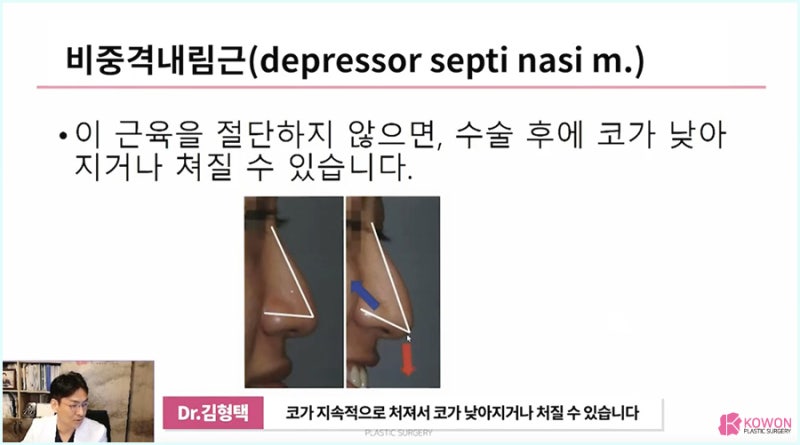 화살코성형 잘하는 곳 비중격내림근 절단 사진 11