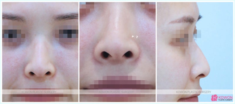 콧대높이기 시술 잘하는 코성형외과추천