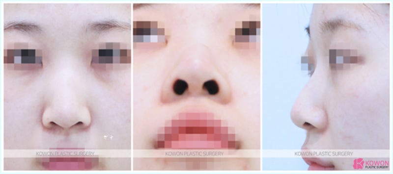 긴코성형 이곳에서 여성스러워진 여자코수술후기